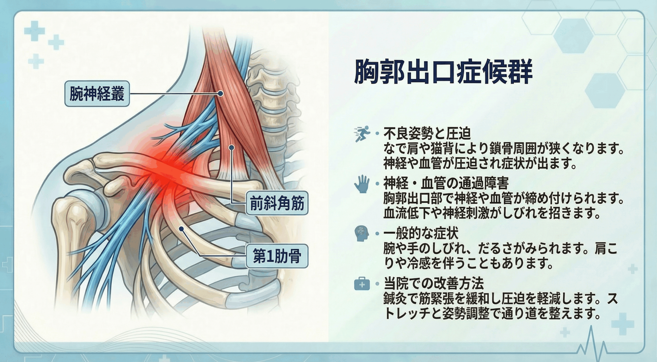胸郭出口症候群の症状イメージ