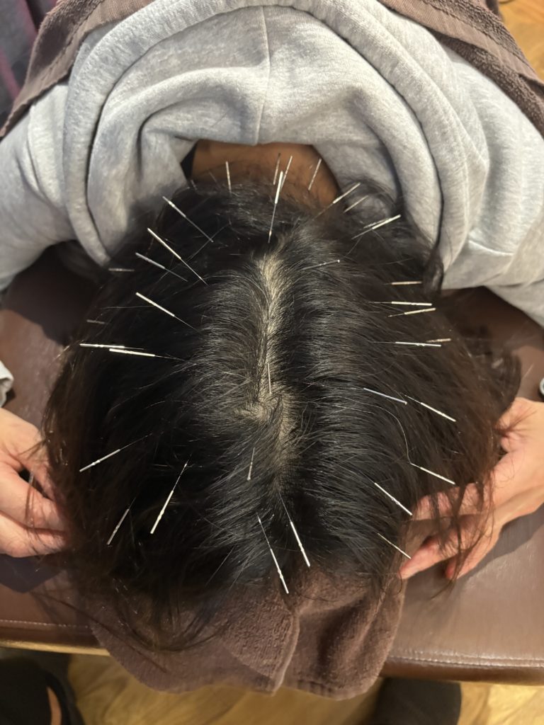 【広陵町】今話題の育毛鍼灸とは？みやこ鍼灸整骨院の育毛施術について