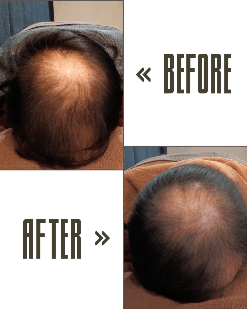 薬を使わない育毛という選択|副作用の心配がない育毛鍼灸