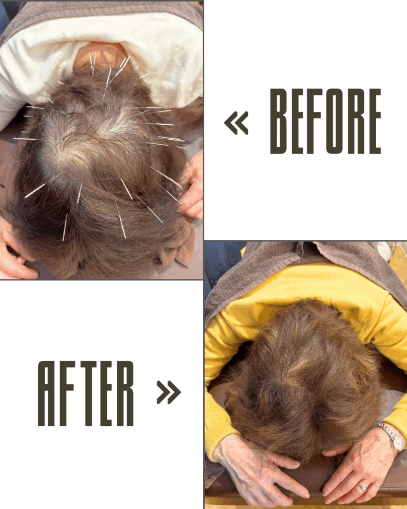 頭皮が硬い=危険サイン?柔らかい頭皮との違い